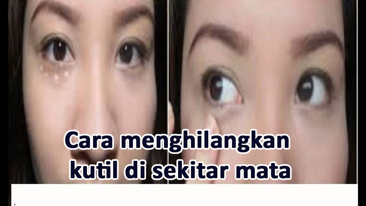 Cara Menghilangkan Kutil Di Sekitar Mata Tanpa Rasa Sakit