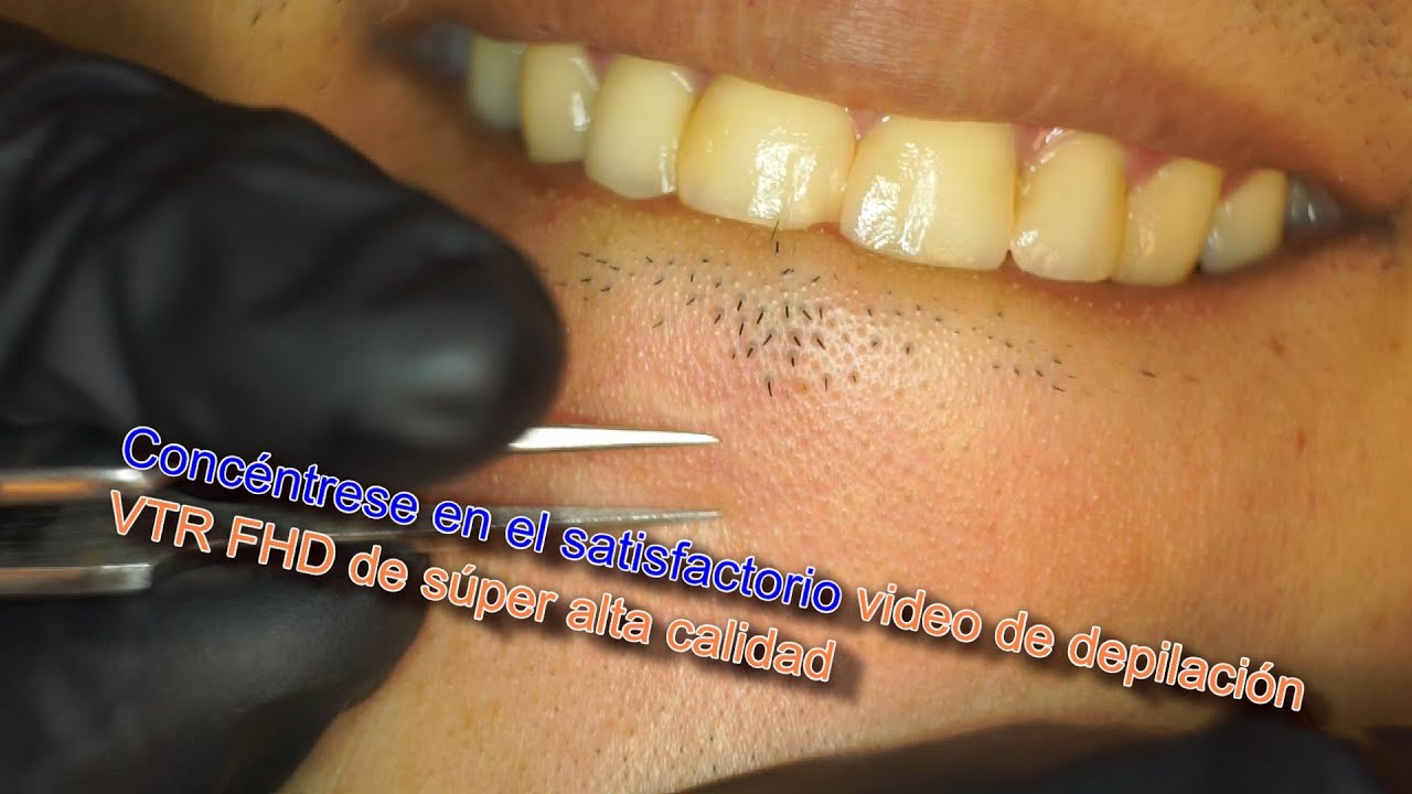 Extracciones de vello no deseado en el mentón FHD l Pinzas Barba l 2021