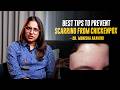 Chicken Pox வந்தா இத மட்டும் பண்ணவே கூடாது! - Dermatologist Dr Monisha Aravind Explains
