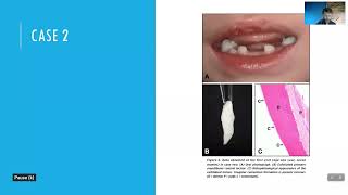 Hypophosphatasia and the Dentist - Charlie Clark, DMD screenshot 5