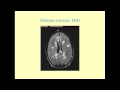 Multiple Sclerosis - CRASH! Medical Review Series
