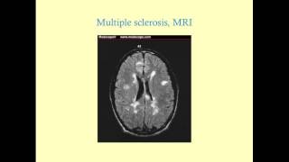 Multiple Sclerosis  CRASH! Medical Review Series