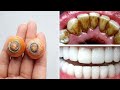 Best teeth whitening at home in 2 Minutes | blanchiment dentaire طريقة تبييض الأسنان في دقيقة