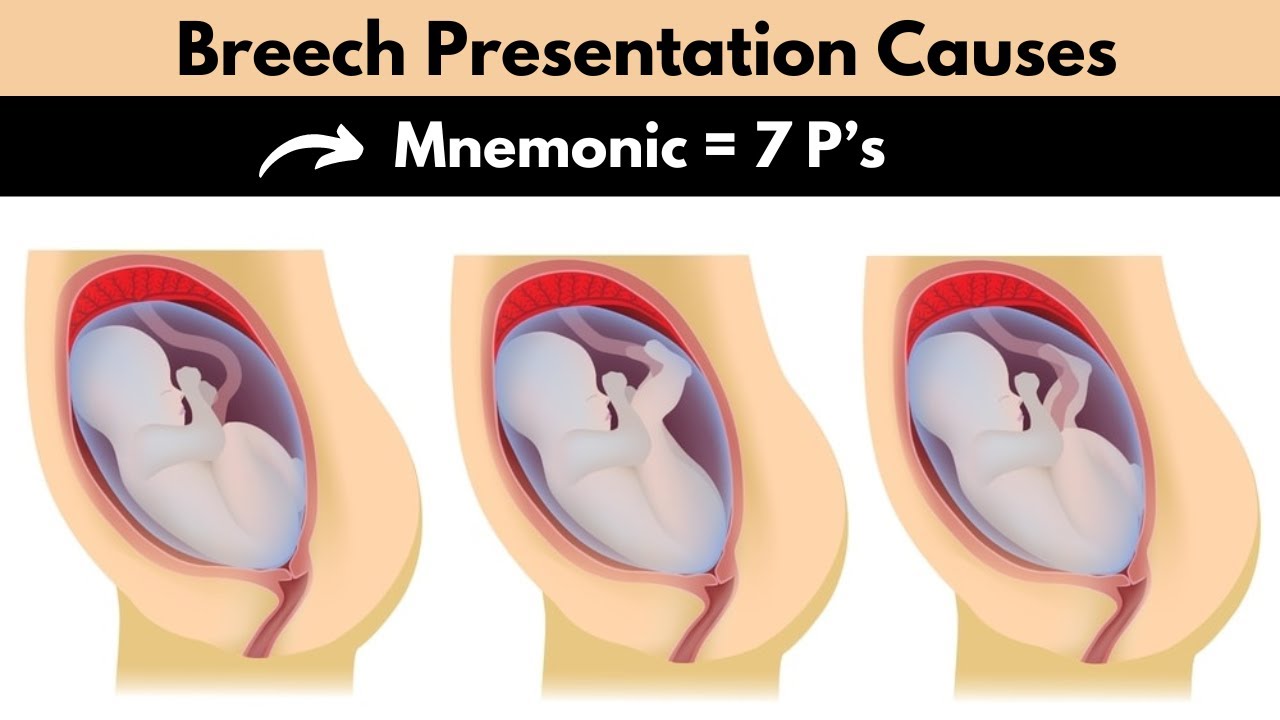 breech presentation 17 weeks