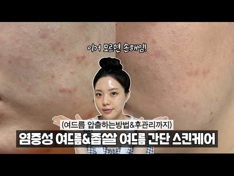 [광고X] 화농성 여드름&amp;amp;<strong>좁쌀여드름</strong> 빠르게 없애기 | 이거 모르면 손해임! , 여드름 압출방법과 후관리까지! 스킨케어하면서 설명해 줄게요 | 자기전 <strong>스킨케어</strong>- [귄펭]
