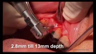 Adin Implant placement   Flap method