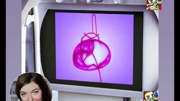 A Yolo Based Model for Breast Cancer Detection in Mammograms