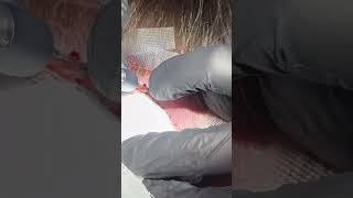 #hairfollicles