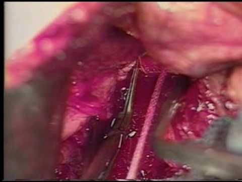 End to side portocaval anastomosis for portal hypertension and bleeding varices
