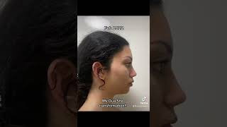 2 Month Gua Sha Transformation Results Tutorial Reliable Beauty Gurus Bella Hadid Face Lift Tut