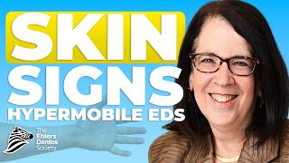 Dr. Clair's Guide to Skin Hyperextensibility: Assessing Skin Involvement, Causes, and Treatment screenshot 5