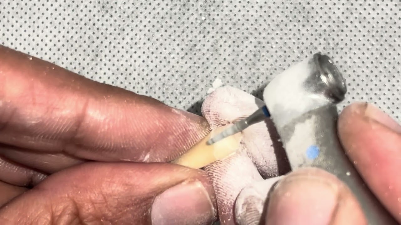 Wing Preparation for Porcelain-Fused-to-Metal (PFM) Crown on Upper Premolar #25 #15
