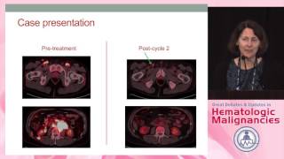 How should we use a Deauville score when employing PET imaging for our lymphoma patients?