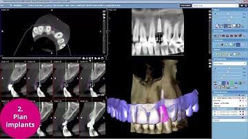 Planmeca Romexis® – Complete Implant Workflow