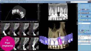 Planmeca Romexis® – Complete Implant Workflow