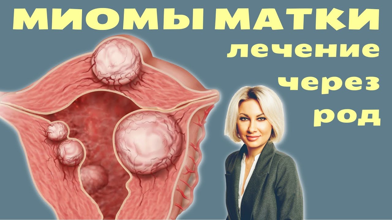 Занятие Сексом При Миоме