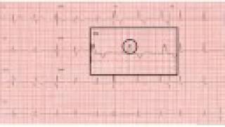 ECG Course 2