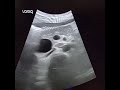 pancreatic Pseudocyst | Doppler Ultrasound | Pancreatitis | Abdomen | Pathology | Radiologist