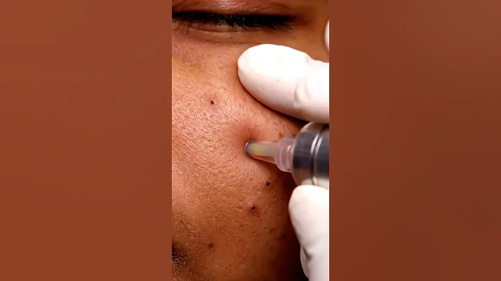 “ASMR Blackhead Vacuum in 4K – Whisper Edition!”