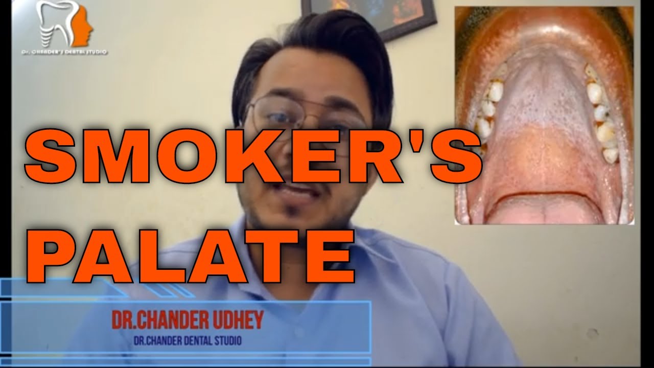 SMOKER'S PALATEEXPLAINED BY DR.CHANDER UDHEY BEEDI CIGARETTE