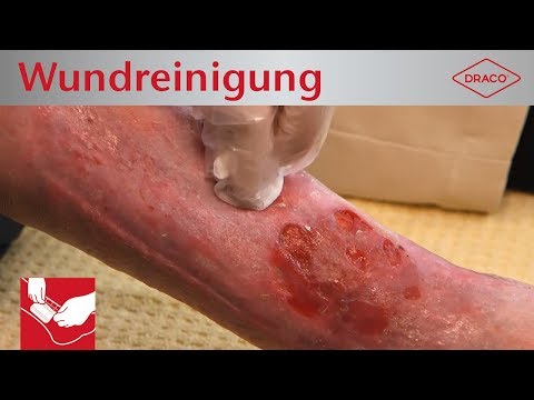 Video: Wer kann Debridement durchführen?