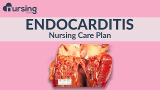 What is Endocarditis, and how to write a care plan for it as a nurse... Nursing care plan