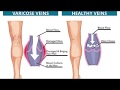 Swelling in the Legs and Feet - Imtiyaz I Kapadwala DPM Vascular Podiatrist in Brooklyn-Ridgewood NY