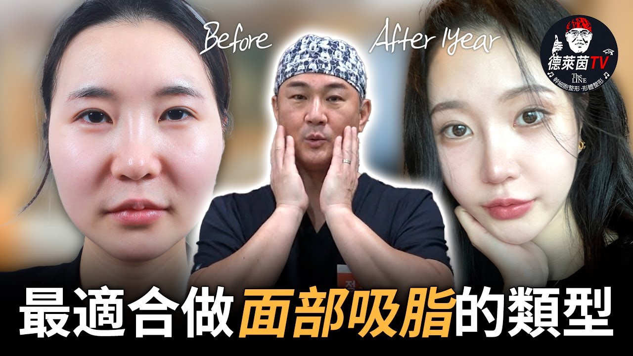 面部吸脂適合哪些人？醫師從臉型、脂肪層到年齡完整解析