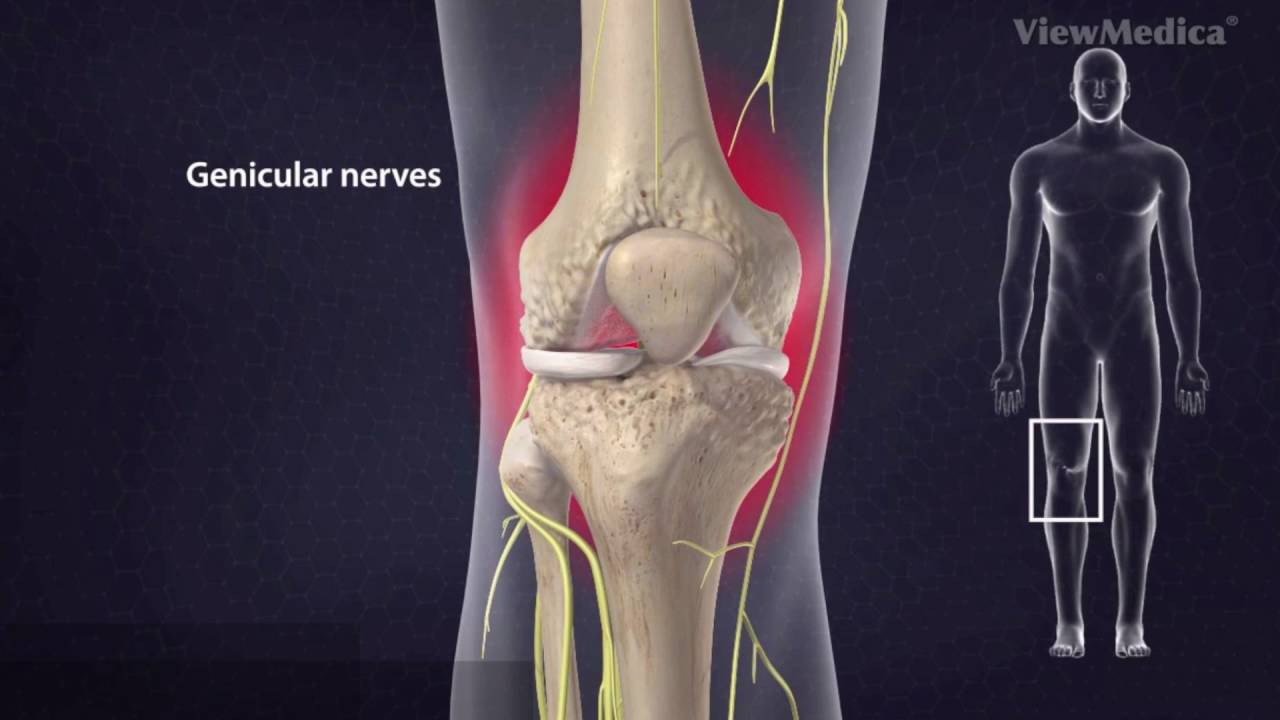 video editing software free Ablacion de Nervios Geniculados por Gonartrosis