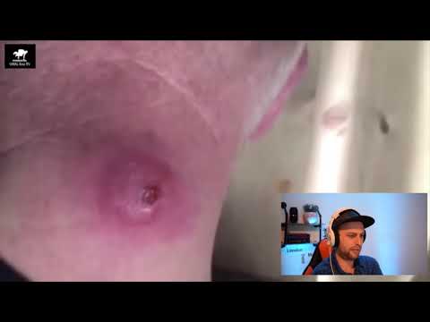 Massive Cyst Popping on the Neck of this man, infected cyst