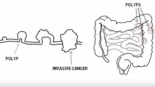 The Basics of Colorectal Cancer (5 W's)