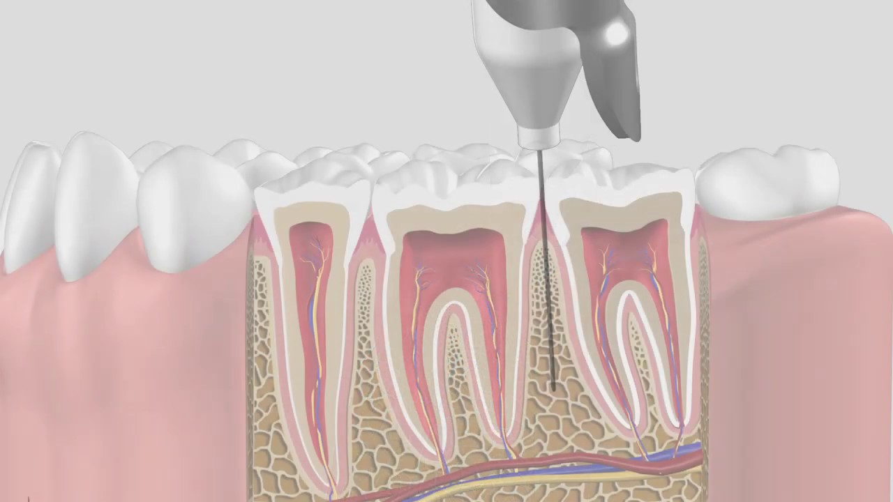 Protocolo QuickSleeper 5, Anestesia Intraosea Osteocentral