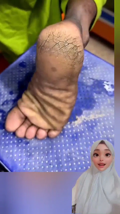 حل تشققات القدمين