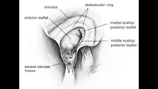 Anomalies Mitrales DIU CPC 2021 D Bonnet