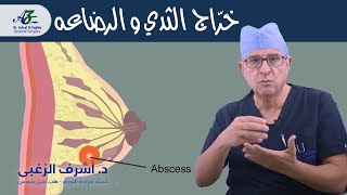 خراج الثدي و الرضاعه  - أ.د/ اشرف الزغبي