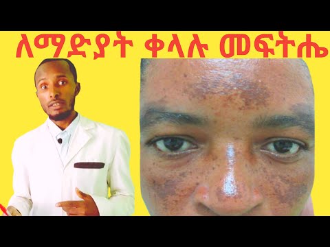 100% ዉጤታማ ‼ ማድያት በቀላሉ ለማጥፋት ተፈጥሮአዊ መፍትሄዎች Melasma causes and easy home treatments