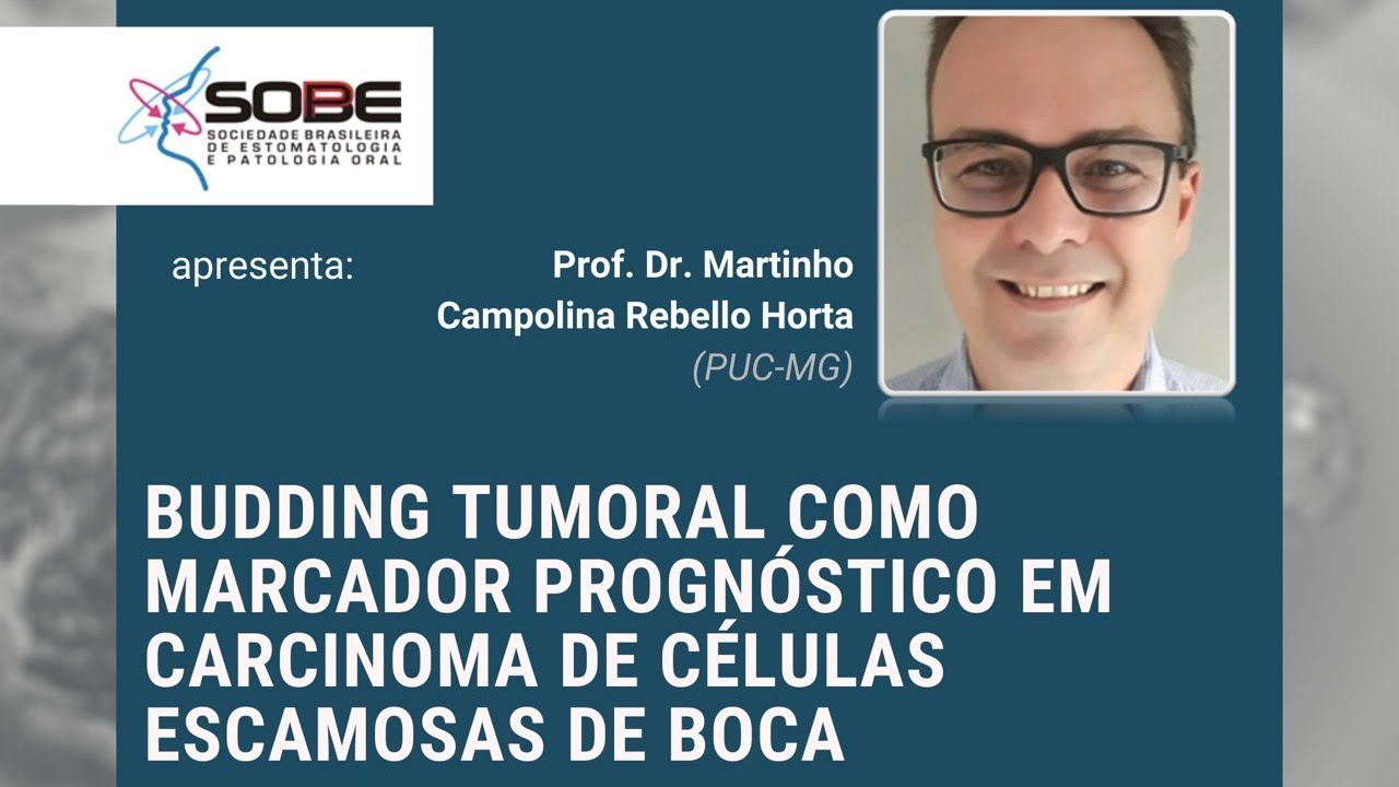 Budding Tumoral como marcador progn&oacute;stico em carcinoma de c&eacute;lulas escamosas de boca