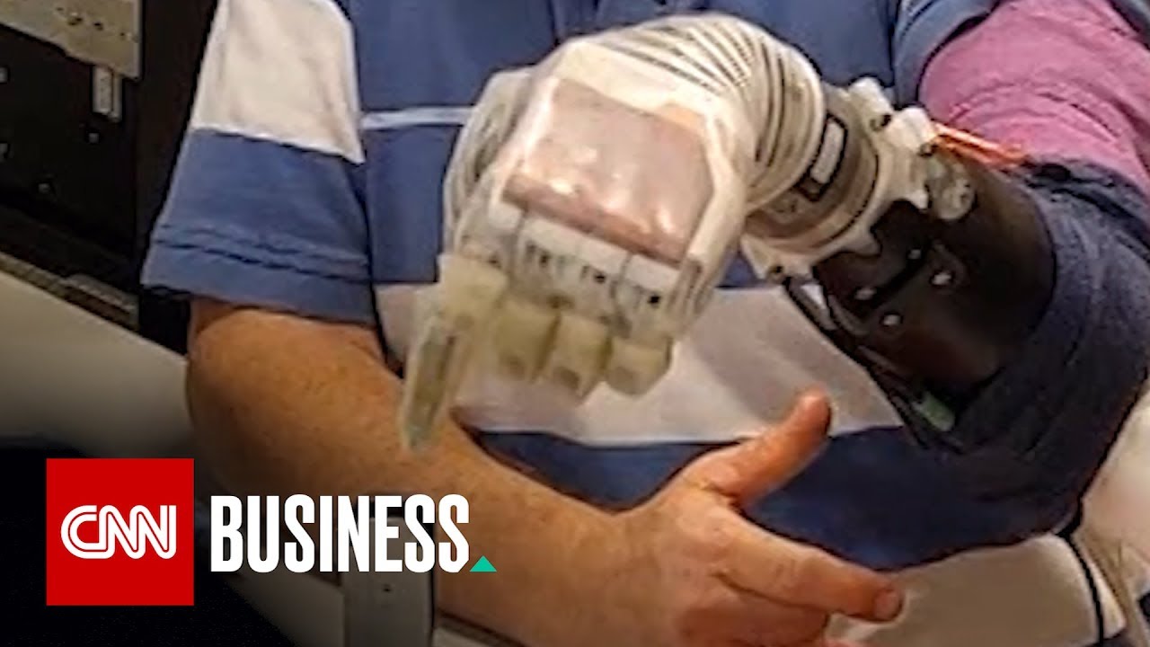 'Star Wars'-inspired prosthetic arm helps amputees feel again