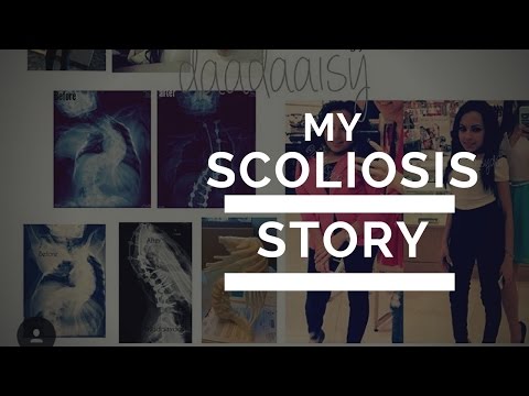 What Kode Icd X Scoliosis