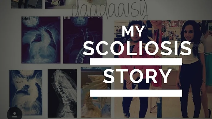 My scoliosis story| My surgery (with Pictures)|Dai...