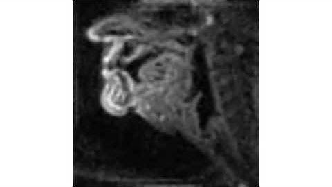 Real-Time Magnetic Resonance Imaging in Patient 3