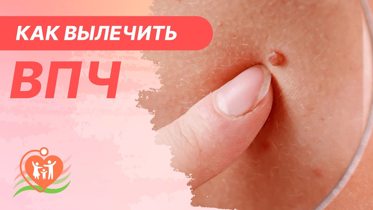 🧬​ Вирус папилломы человека. Как вылечить ВПЧ?
