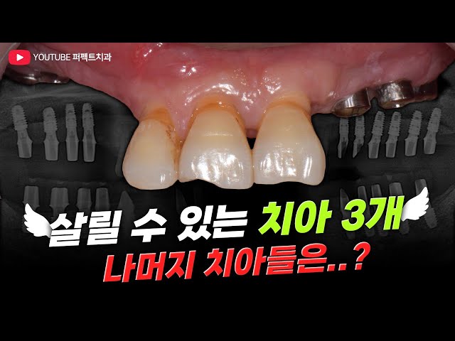 앞니 3개로 전체임플란트를❓ 풀아치임플란트 안하는 이유