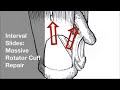 Interval Slides for Massive Rotator Cuff Repair