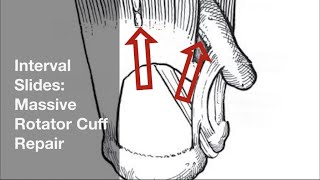 Interval Slides for Massive Rotator Cuff Repair