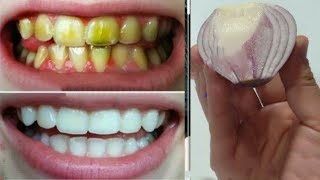 تبييض الاسنان واسقاط الجير في ١ دقيقة فقط،حول اسنانك من صفراء الى بيضاء لامعة كاللؤلؤ من اول استخدام