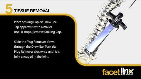 Thingee - Osteotech: FacetLink