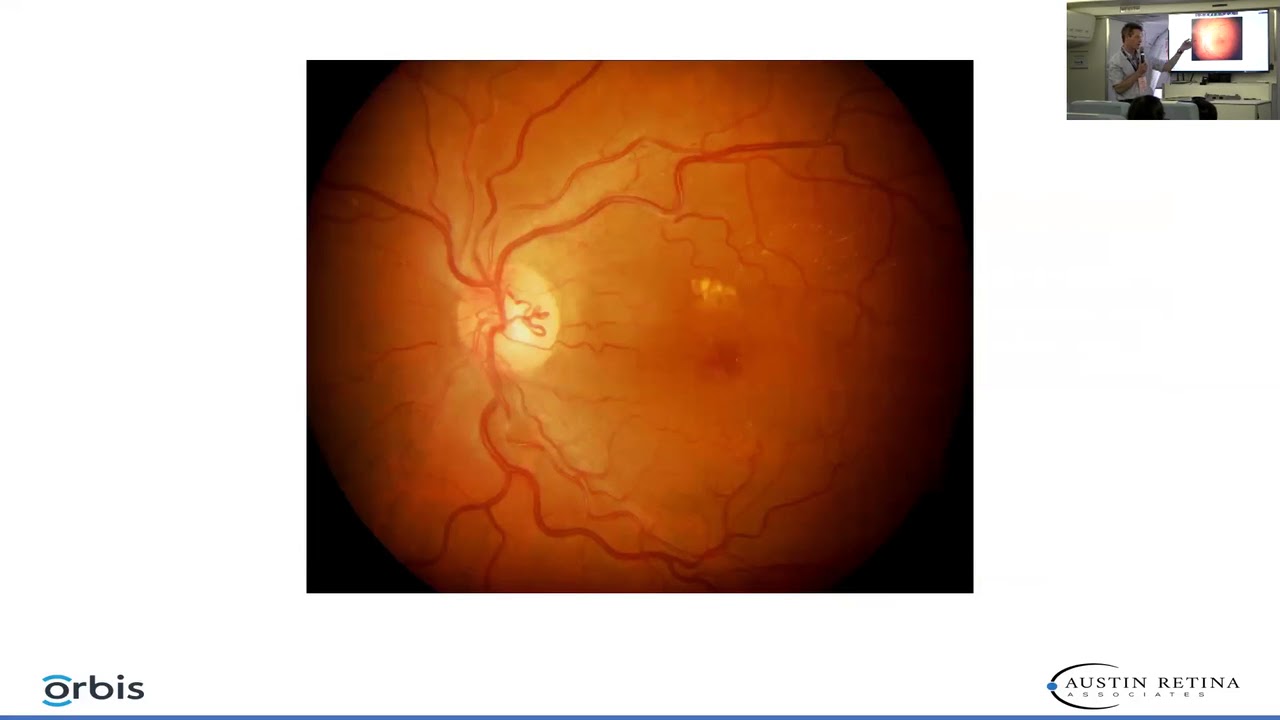 Indications for Retina Laser Treatment Dr. Clio Armitage Harper III