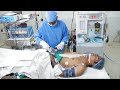 Anesthesia for Rhinoplasty Cosmetic Surgery - Intubation - General Anaesthetic