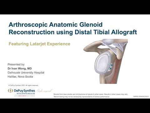 Dr. Ivan Wong Presents Glenoid Reconstruction using Distal Tibial Allograft for Shoulder Instability